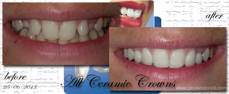 Al Ceramic crowns&bridges